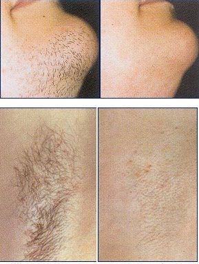 IPL Hair Removal Device – 9 Levels of Irradiation & 2 Modes