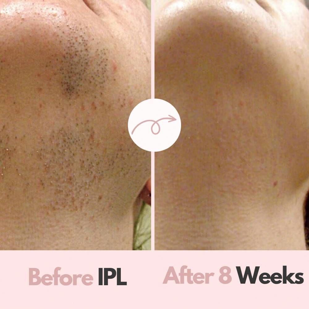 IPL LAZER-HAIR REMOVER REMOVER THE PERMENENT HAIR